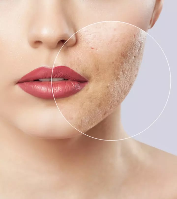 Acne Treatment