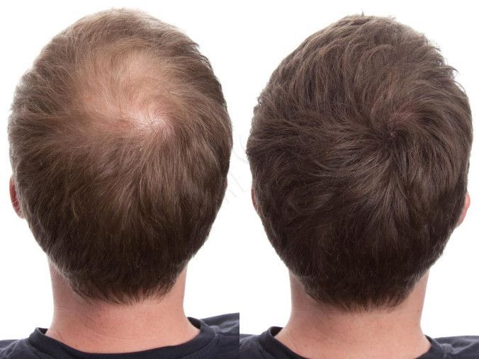Hair Loss Treatment