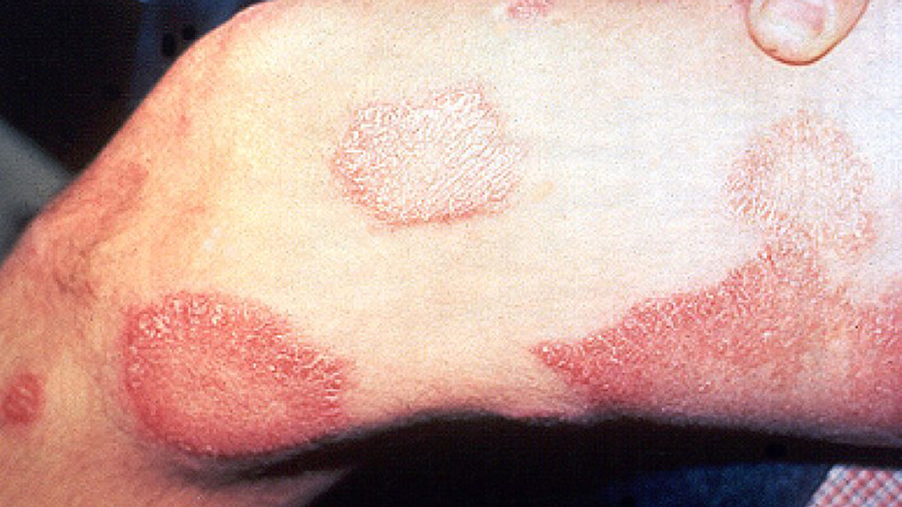 Leprosy Treatment