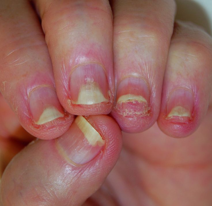 Nail Disorders