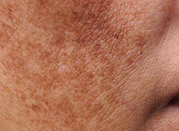Pigmentation Management