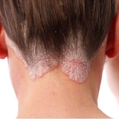 Psoriasis Treatment